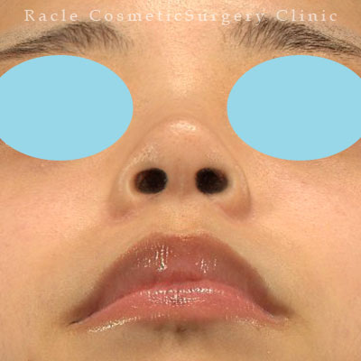 手術後12ヶ月目