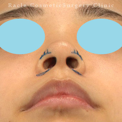 手術前デザイン