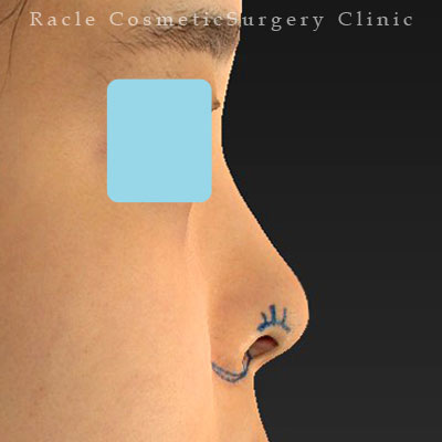 手術前デザイン