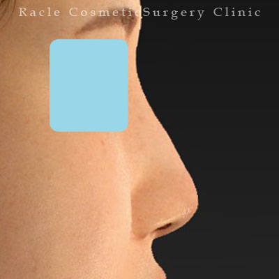 手術後12ヶ月目