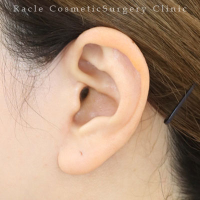 手術後12ヶ月目