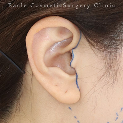 手術前デザイン