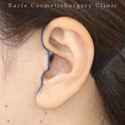 手術前デザイン