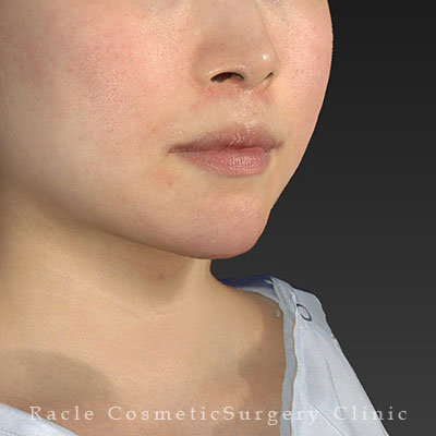 手術後12ヶ月目