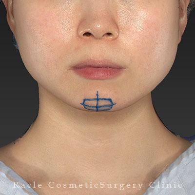 手術前デザイン