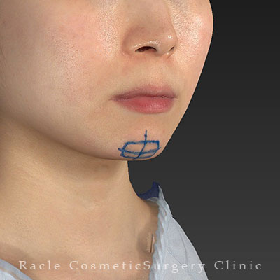 手術前デザイン