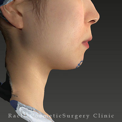 手術前デザイン