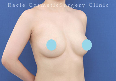 手術後12ヶ月目