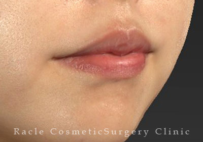 手術後12ヶ月目