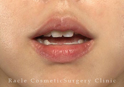 手術後12ヶ月目