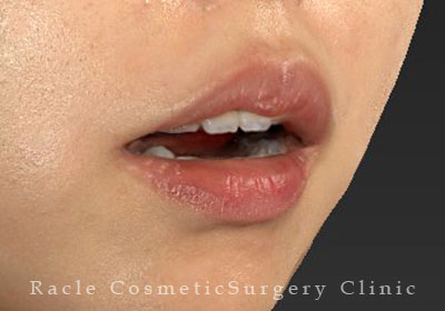 手術後12ヶ月目