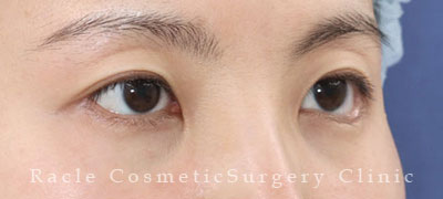 手術後12ヶ月目