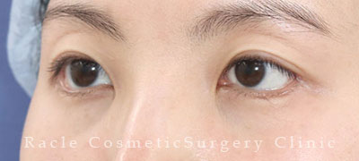 手術後12ヶ月目