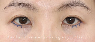 手術前デザイン