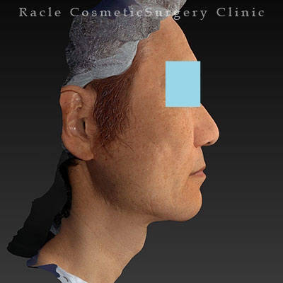 手術後12ヶ月目