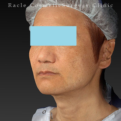 手術後12ヶ月目