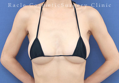 手術後12ヶ月目