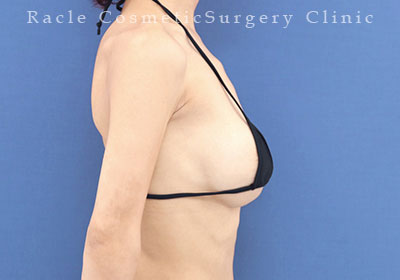 手術後12ヶ月目