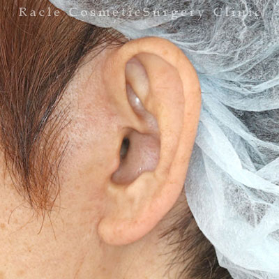 手術後12ヶ月目