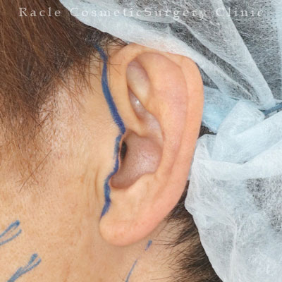 手術前デザイン