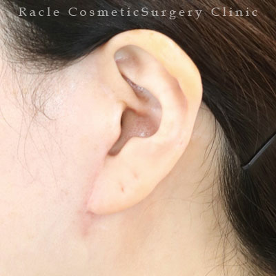 手術後12ヶ月目