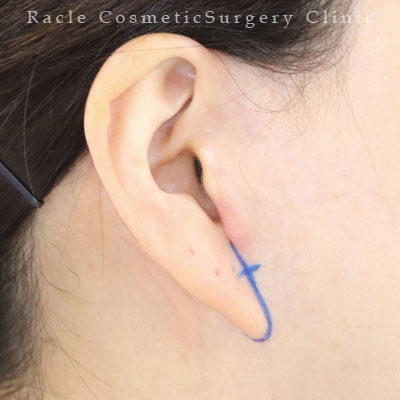 手術前デザイン