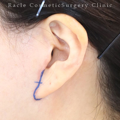 手術前デザイン