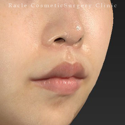 手術後12ヶ月目