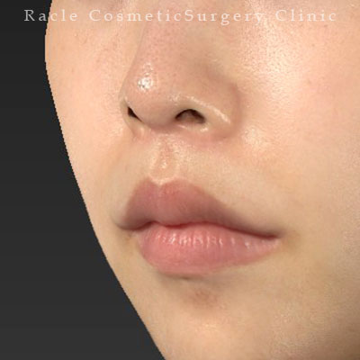 手術後12ヶ月目