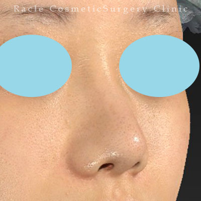 手術後12ヶ月目