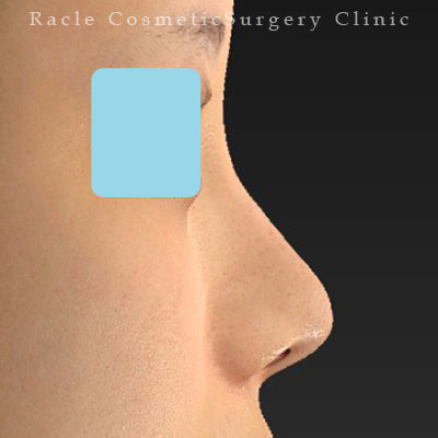 手術後12ヶ月目