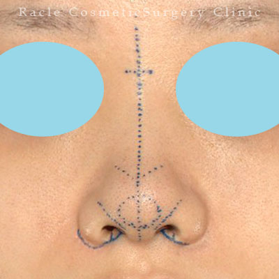 手術前デザイン