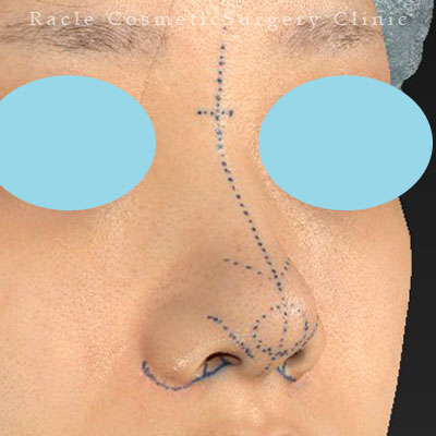 手術前デザイン