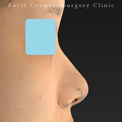 手術前デザイン