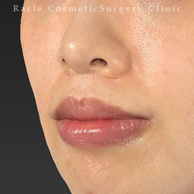 手術後12ヶ月目