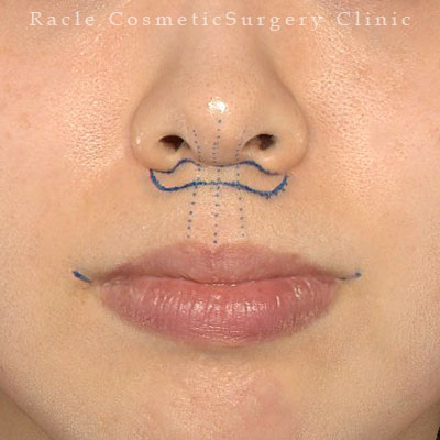 手術前デザイン