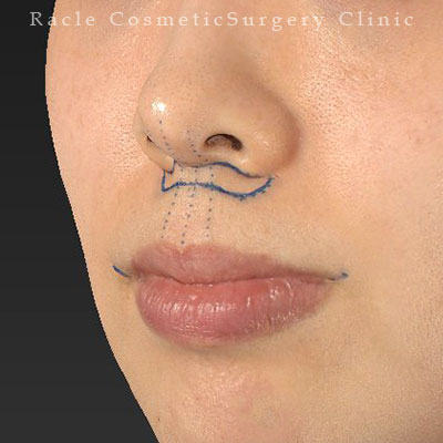 手術前デザイン