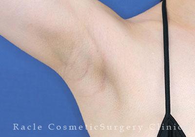 手術後12ヶ月目