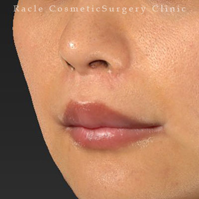 手術後12ヶ月目