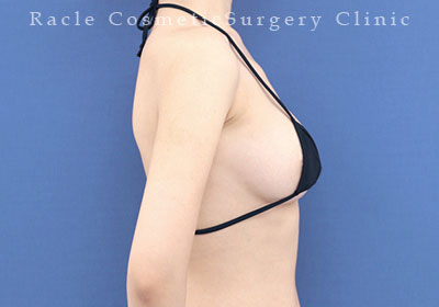 手術後12ヶ月目