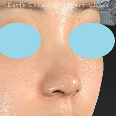 手術後12ヶ月目