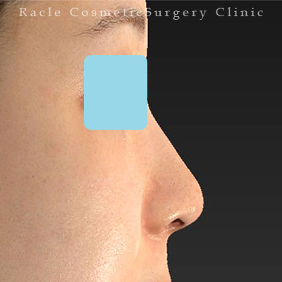 手術後12ヶ月目