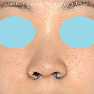 手術前デザイン