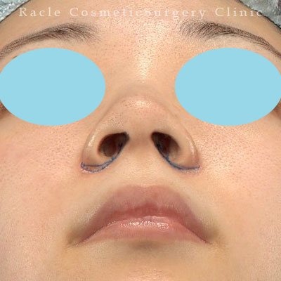 手術前デザイン