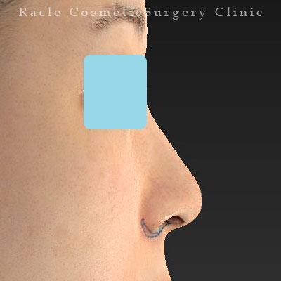 手術前デザイン