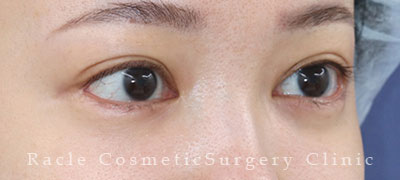 手術後12ヶ月目