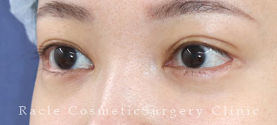 手術後12ヶ月目