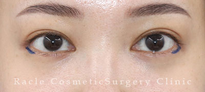 手術前デザイン