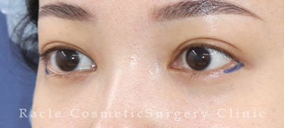 手術前デザイン