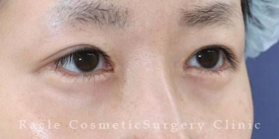 手術後12ヶ月目